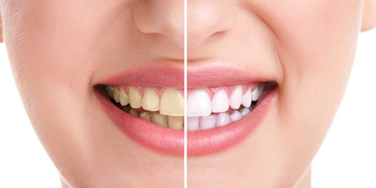 Before After Image of Teeth