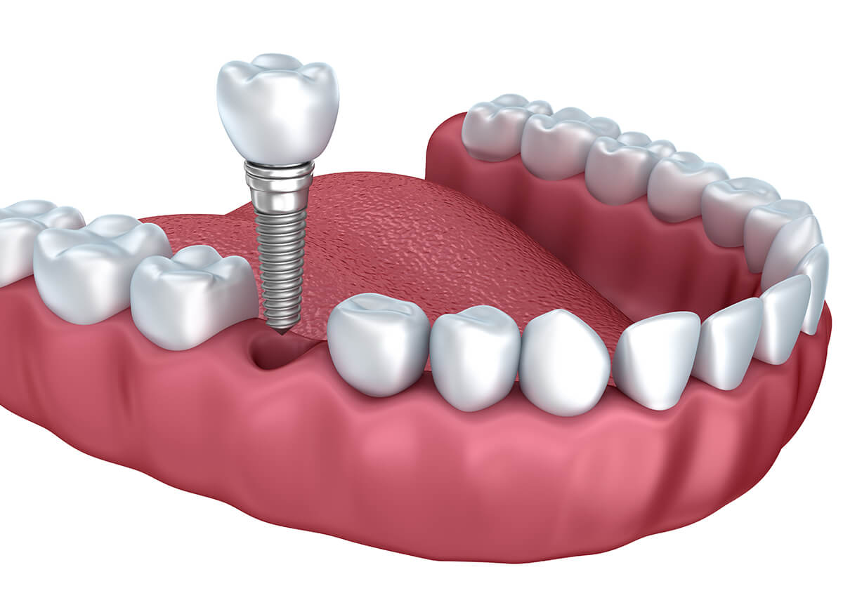 Natural Looking Teeth Implants in Manchester GA Area
