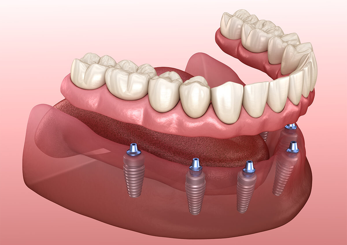 All On 4 Dental Implants in Manchester GA Area