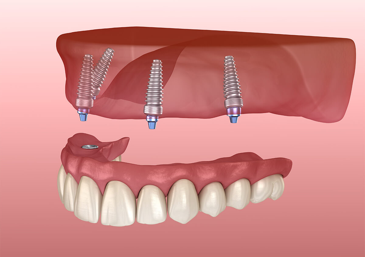 Full Mouth Dental Implants in Manchester GA Area